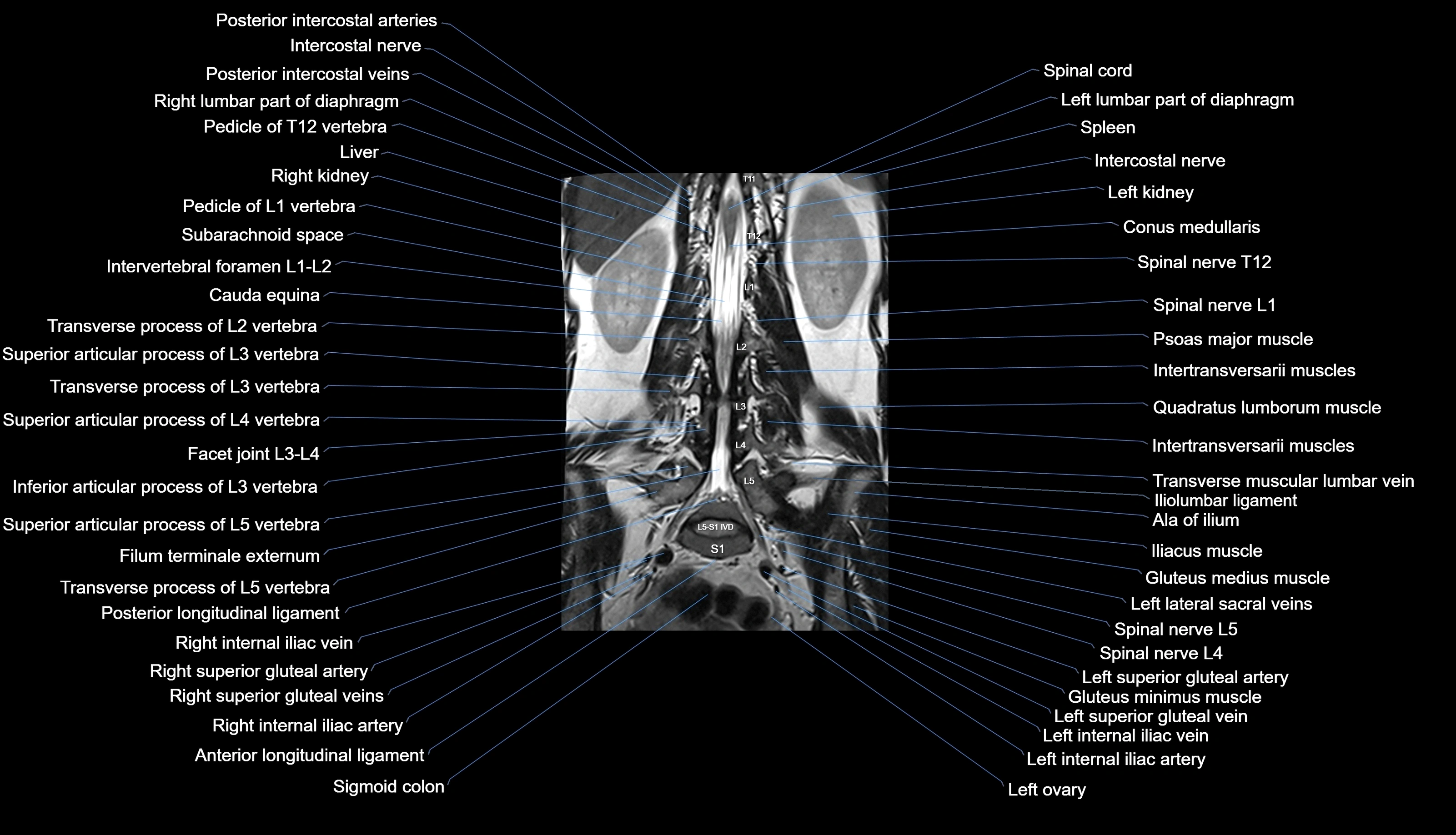MRI lumbar spine labelled coronal cross sectional anatomy 3T radiology-img-00001-00020.webp